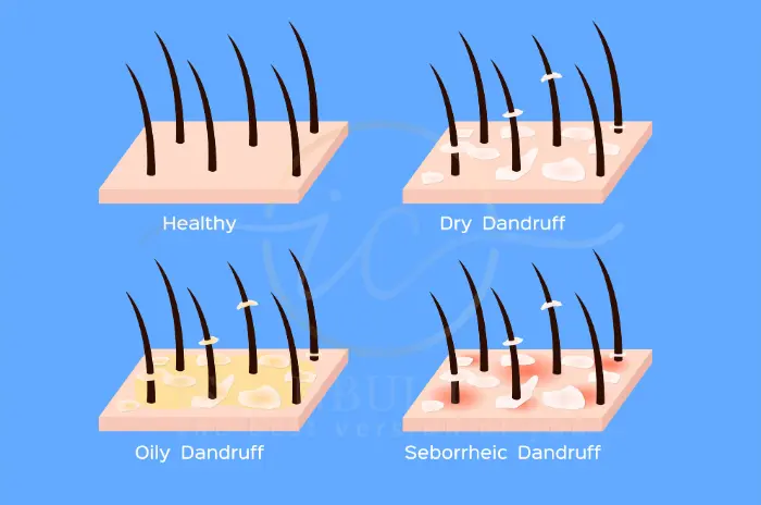 dandruff damage hair follicles dandruff damage hair follicles