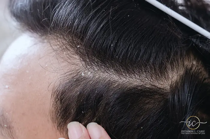 dandruff from hair gel dandruff from hair gel