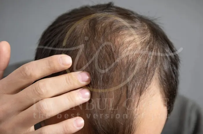 does-mounjaro-cause-hair-loss