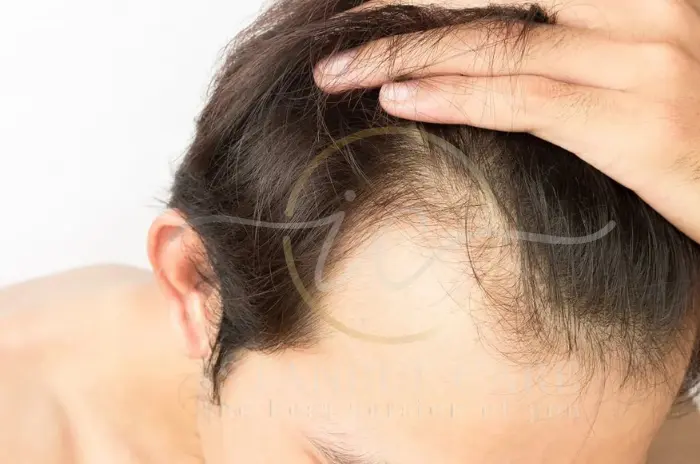 does testosterone cause hair loss