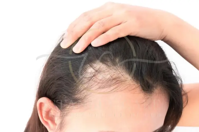 female pattern hair loss female pattern hair loss