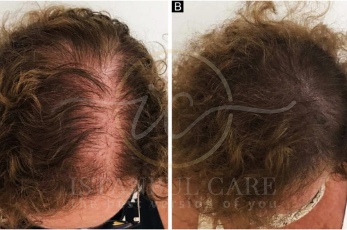 hair loss vs hair growth hair loss vs hair growth