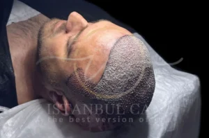 microneedling regrow hair?