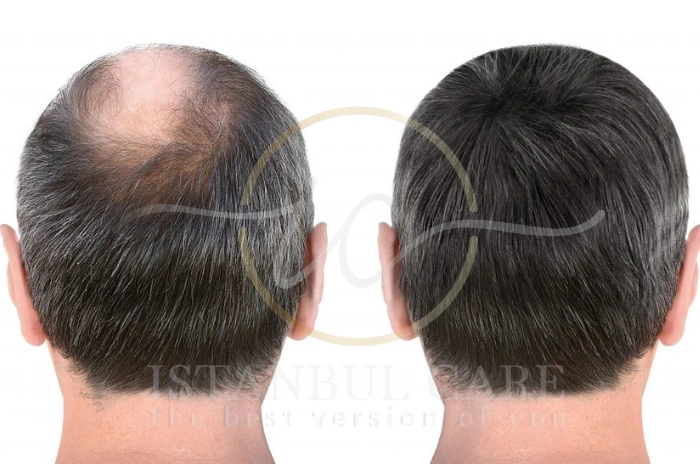 minoxidil side effects
