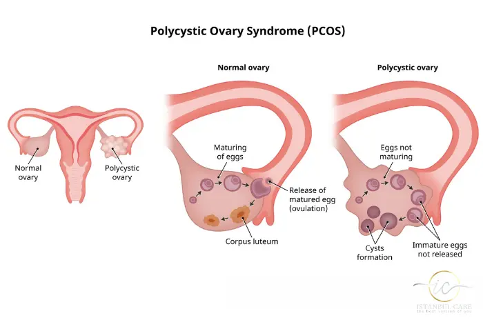 polycystic polycystic