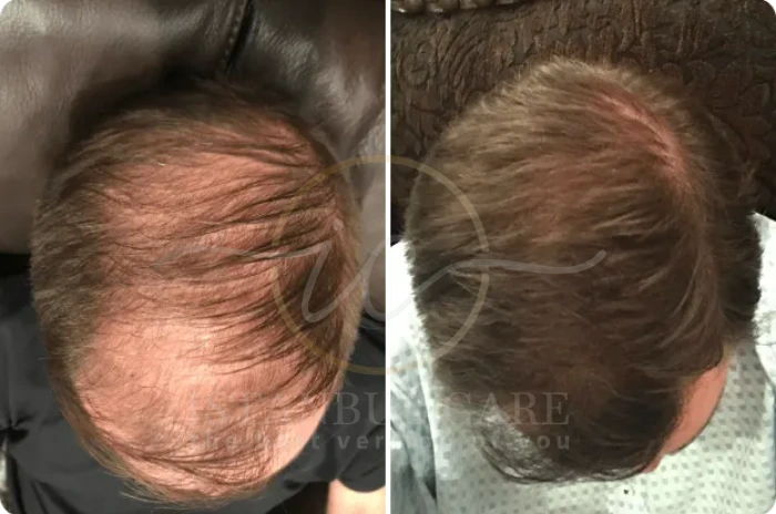 telogen effluvium regrowth telogen effluvium regrowth