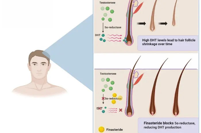 testosterone cause hair loss testosterone cause hair loss