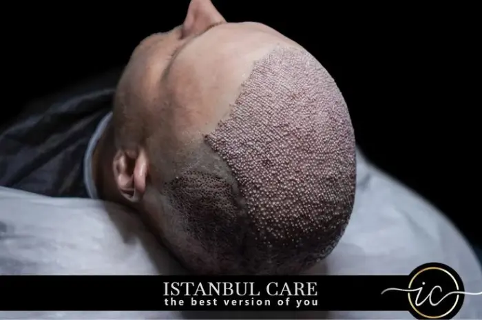 type of hair transplant