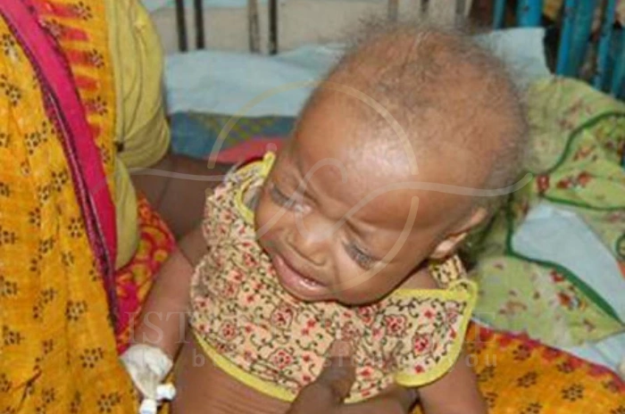 Menkes Kinky Hair Syndrome