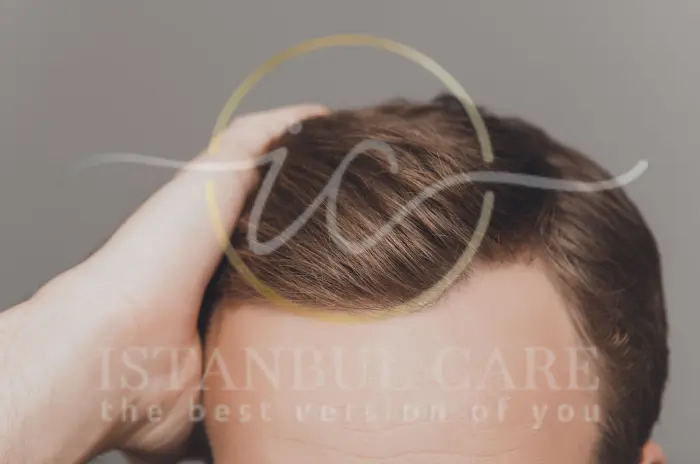 Adrenal Tiredness How Stress Hormones Affect Hair