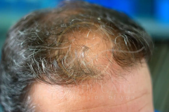 COVID hair loss COVID hair loss