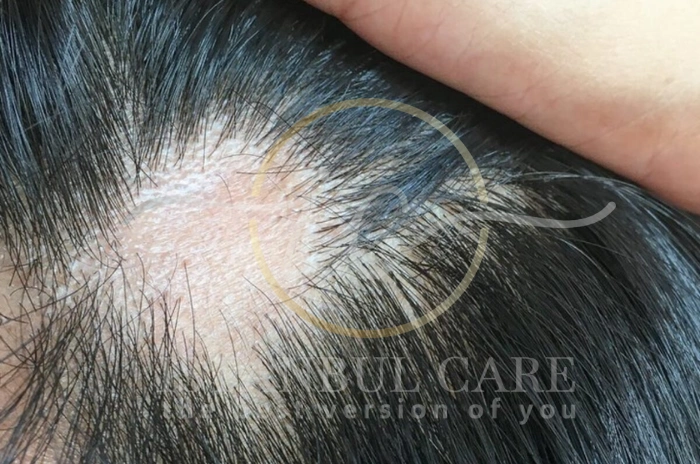 Can hair mold cause hair loss