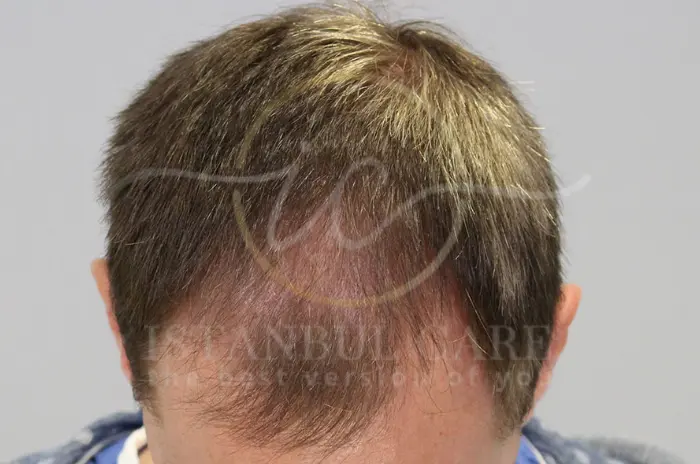 Does Creatine Cause Hair Loss