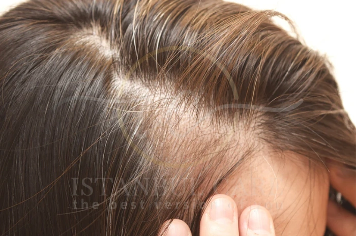 Hair loss after COVID Hair loss after COVID