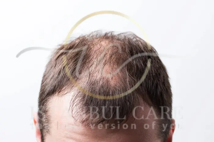 How Do Stress Hormones Affect Hair