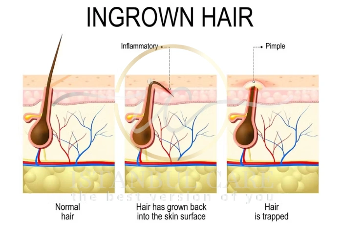 Ingrown hair prevention Ingrown hair prevention