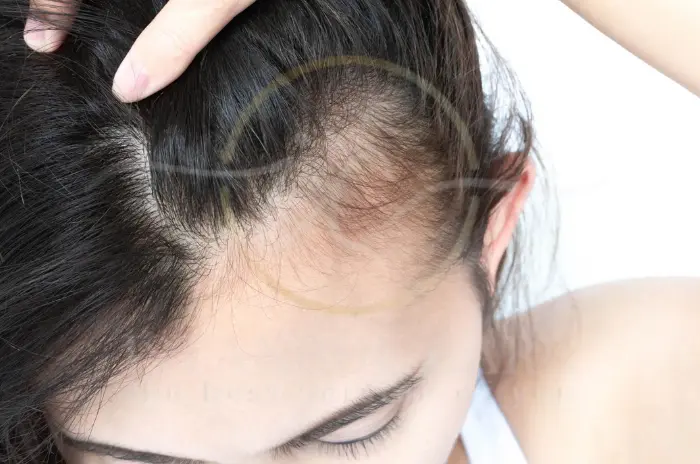 Lupus Hair Loss Symptoms Causes and Treatments (1)