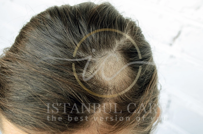 Mold and hair loss Mold and hair loss