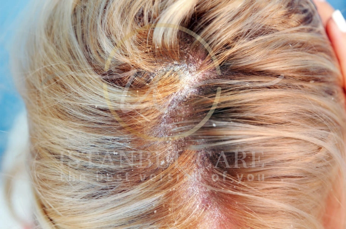Scalp fungal infection