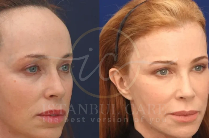 Scalp reduction for hair restoration