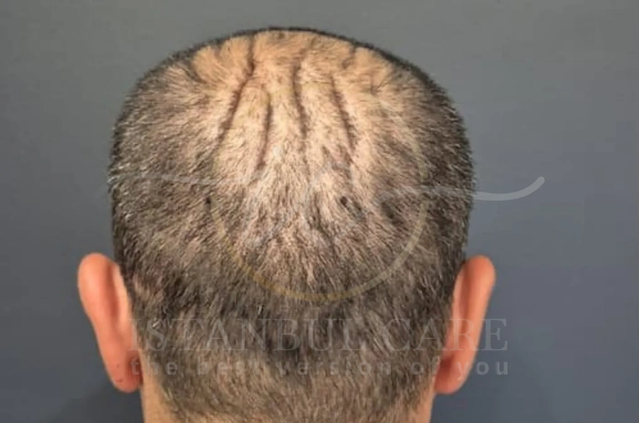 Scalp reduction procedure