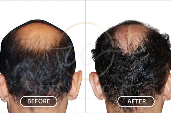 Scalp reduction surgery