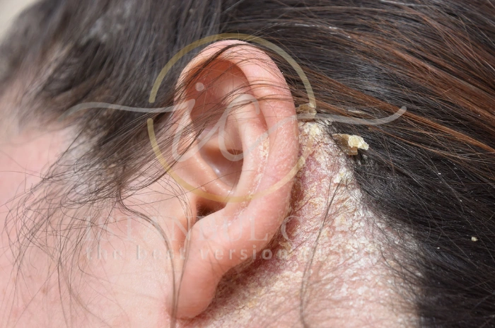 Scalp yeast infection Scalp yeast infection