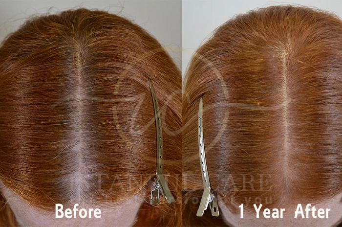 Spironolactone for hair loss Spironolactone for hair loss