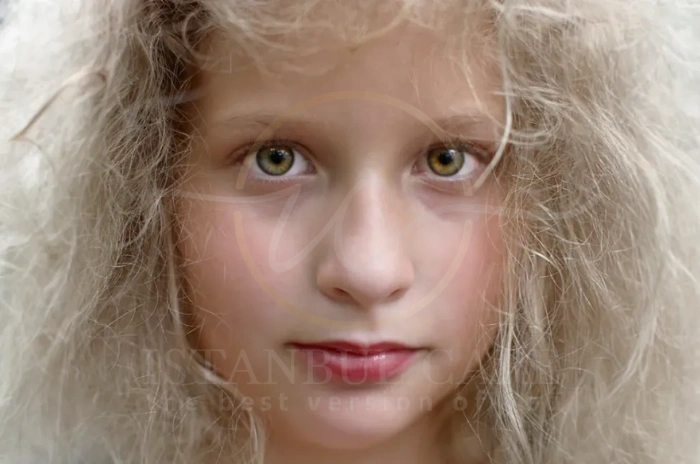 Uncombable hair syndrome Uncombable hair syndrome