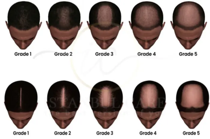 Androgenic Hair Loss - Understanding Androgenic Hair Loss Causes and Mechanisms Understanding Androgenic Hair Loss Causes and Mechanisms