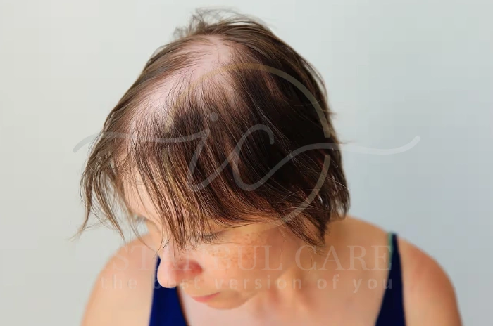 wegovy cause hair loss