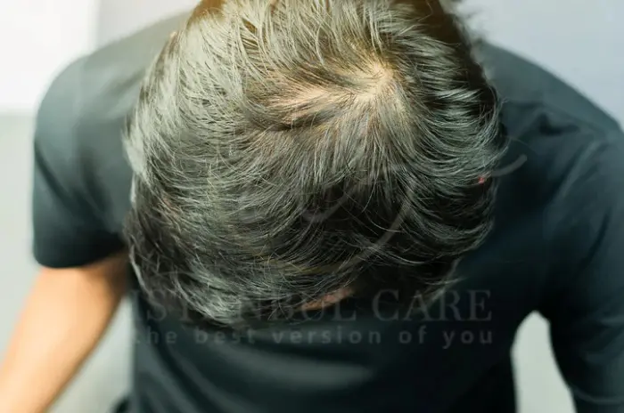 Cowlick Hairline - What Is a Cowlick Hairline and How to Manage Stubborn Hair What Is a Cowlick Hairline and How to Manage Stubborn Hair
