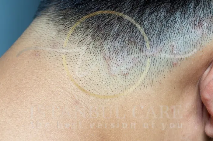 Tinea Capitis Treatment - What Is Tinea Capitis – Causes, Symptoms, and Treatment What is Tinea Capitis Causes and Symptoms