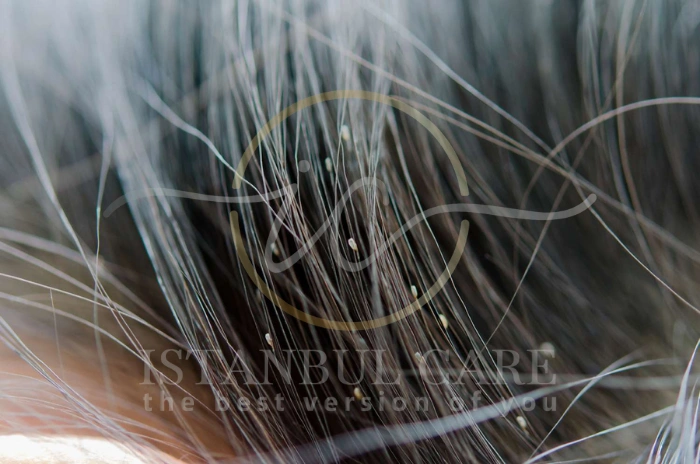 head lice hair treatment