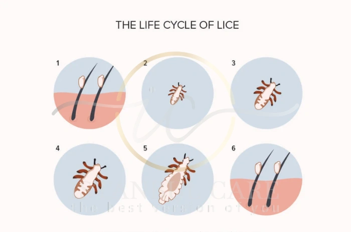 how to get rid of head lice how to get rid of head lice