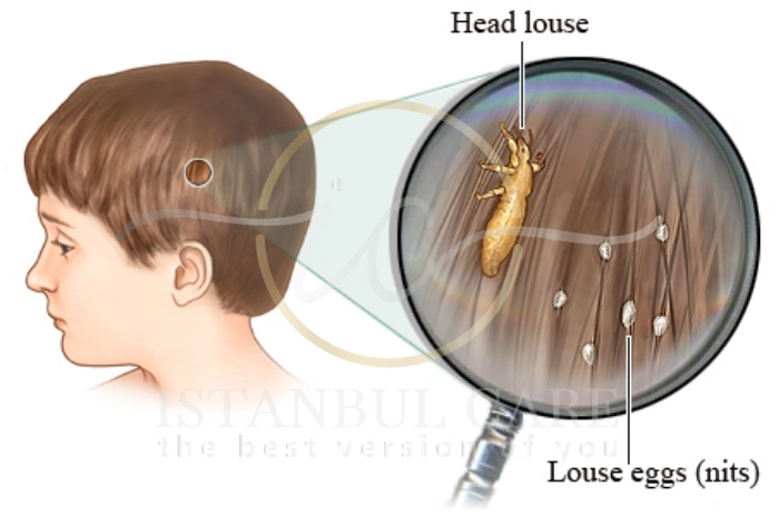 lice treatment lice treatment