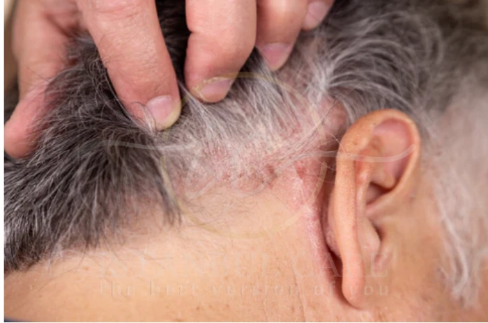 aching scalp hair loss