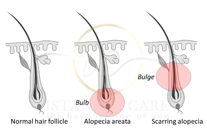 Alopecia treatment