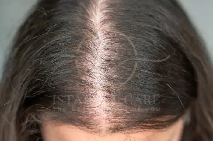 Common Hair Loss Symptoms and Effective Hair Loss