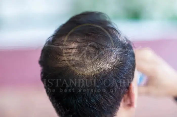 Common Hair Loss Symptoms