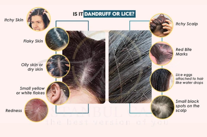 Do I have lice or dandruff