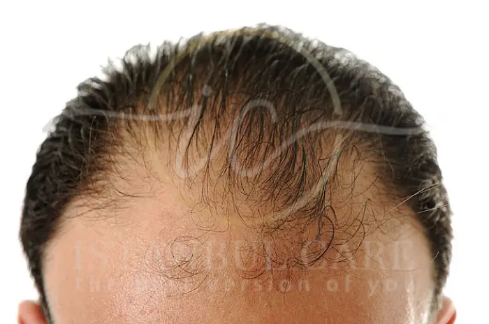 Do Vitamin and Mineral Deficiencies Cause Hair Loss Detailed information