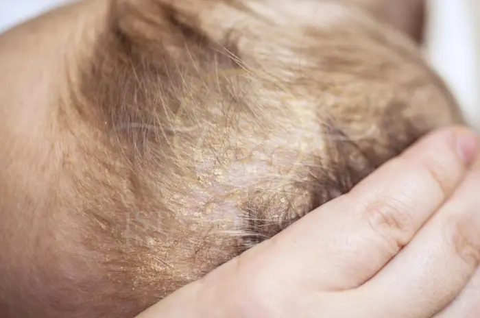 Eczema on Scalp Proven Natural Remedies and Treatments