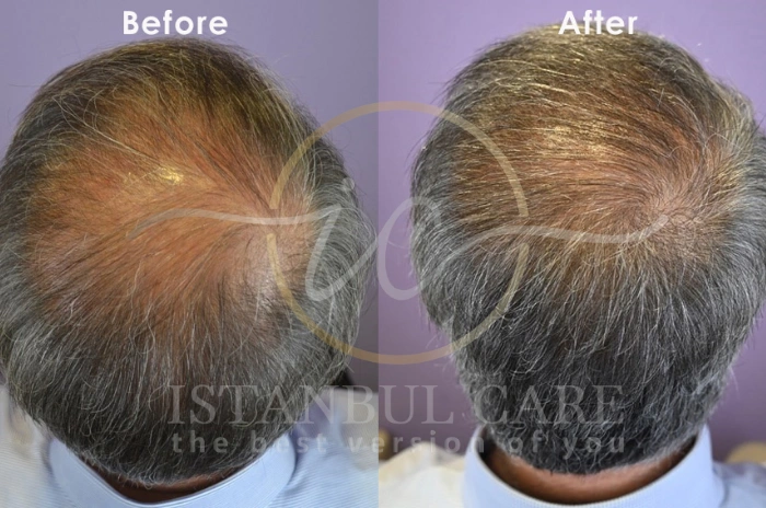 Finasteride before and after