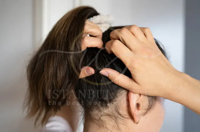 How to Fix Dry Scalp Best Causes Symptoms