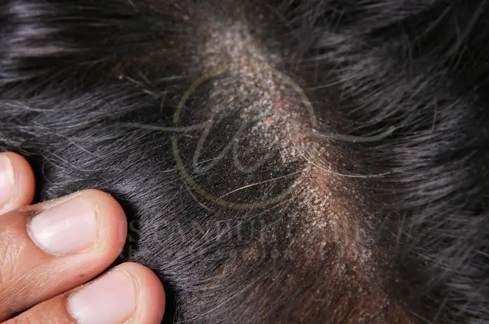 How to Fix Dry Scalp Best Causes Symptoms (1)