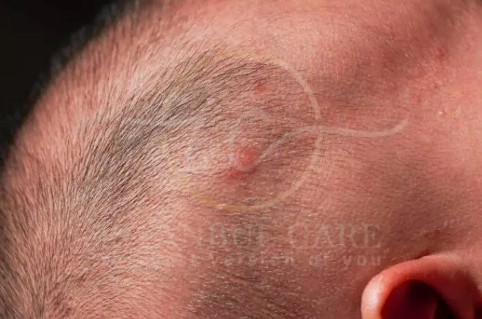 Pimples on Scalp Causes and Effective Treatments