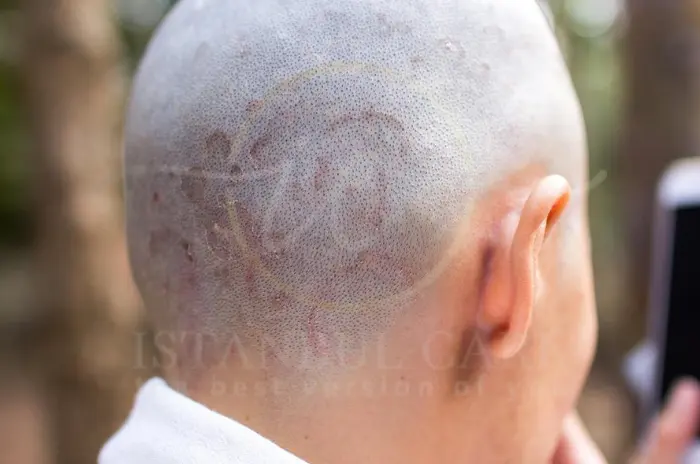 Ringworm in hair signs causes and safe care treatments