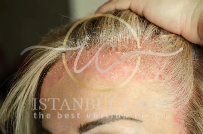 scalp psoriasis treatment - Scalp Psoriasis Treatment Options and Management Scalp Psoriasis Treatment Options
