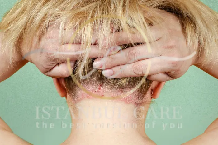 Scalp Psoriasis